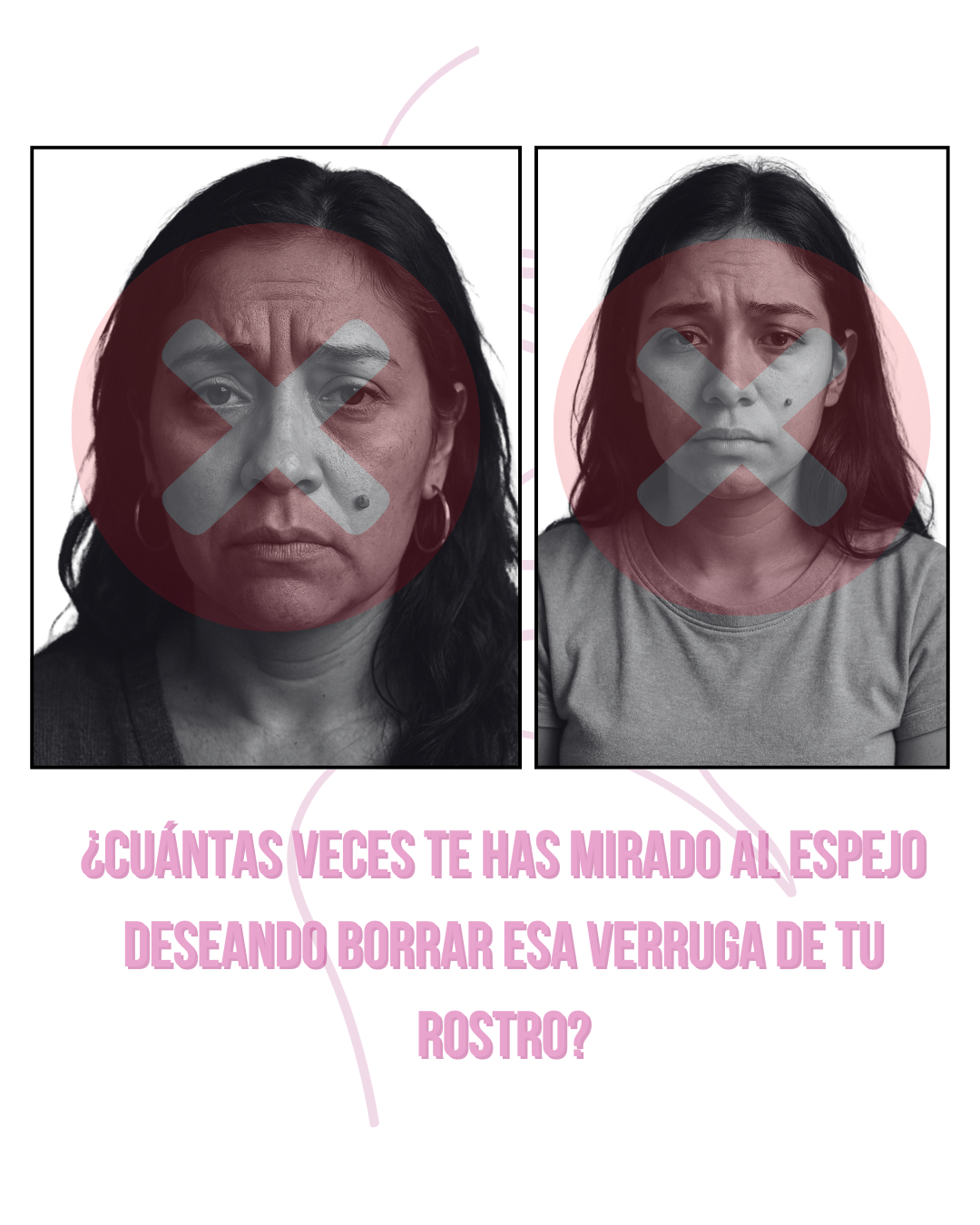 Luminiix Eliminador De Verrugas